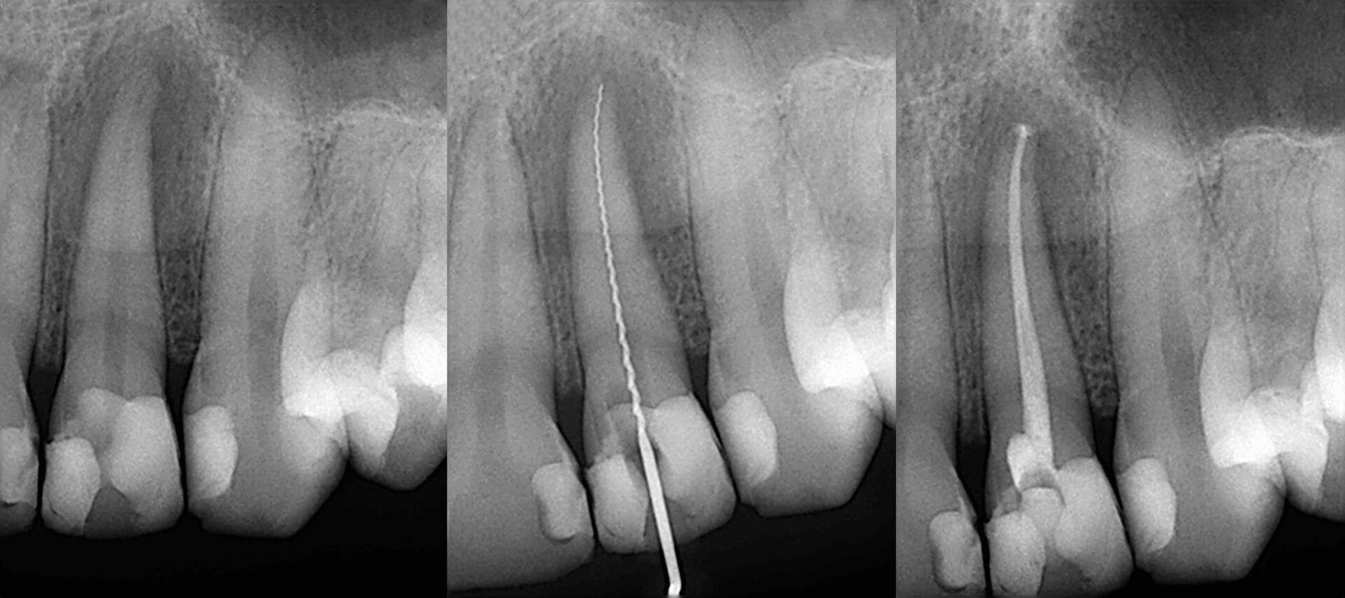 X-ray photos of before and after endo treatment protocol. Black and white photo.X-ray photos of before and after endo treatment protocol. Black and white photo.